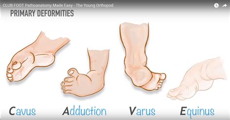 scratch test ctev|Interventions for congenital talipes equinovarus (clubfoot).